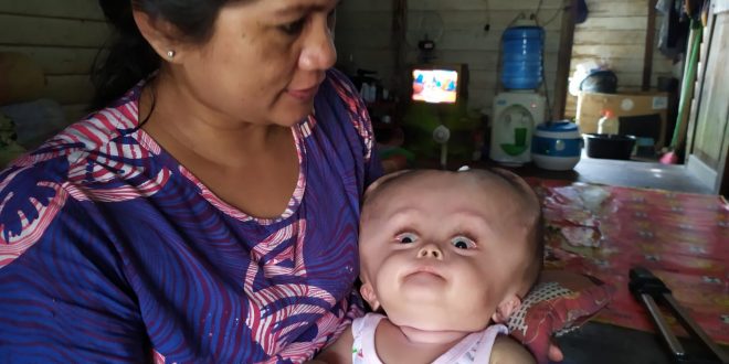 Butuh Uluran Tangan, Bayi 8 Bulan Penderita Hidrosefalus